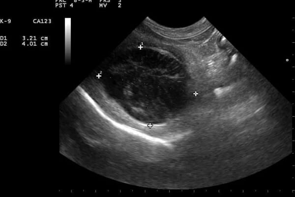 Ultrasound image showing a gallbladder mucocele, photo