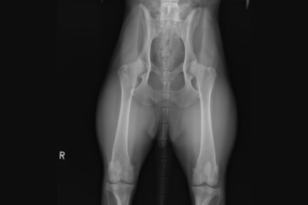 Radiograph of hips showing bilateral hip arthritis.