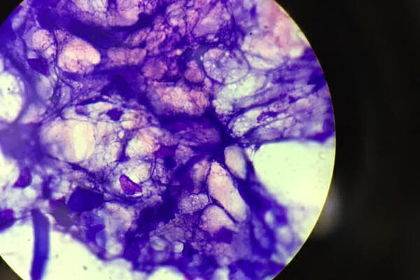 Microscopic image of a sebaceous cyst, photo