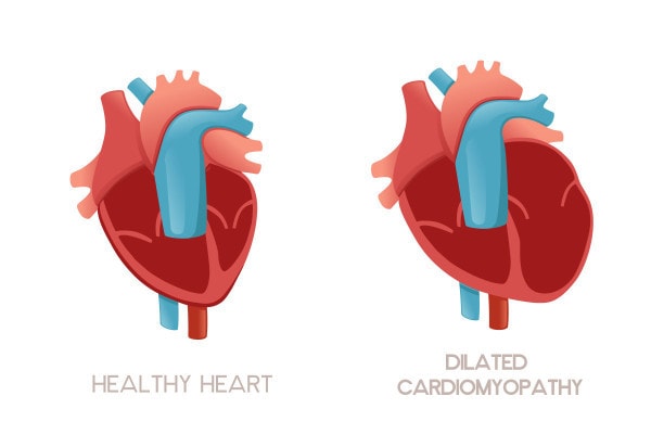 Graphic of 2 hearts that show the difference between a normal, healthy heart and a heart with dilated cardiomyopathy where the dog's heart chamber size is larger