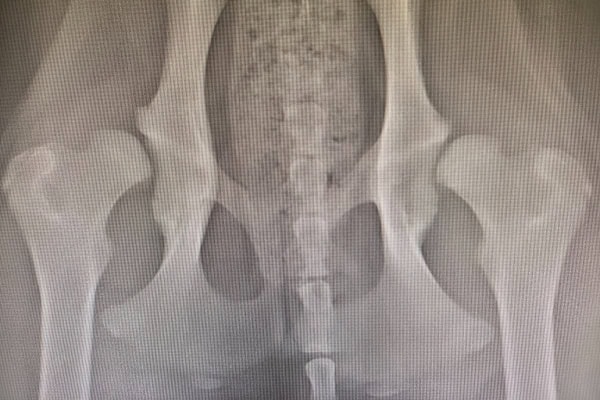 X-ray showing bilateral severe hip dysplasia with dislocated hips
