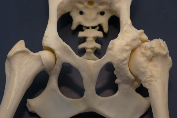 Mold of a dog's pelvis showing severe arthritis in one hip that will need canine hip replacement surgery