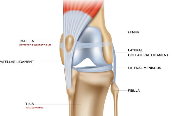 Diagram of a medially luxating patella