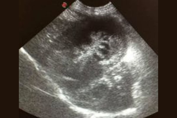 Abdominal ultrasound image of a gallbladder mucocele, photo