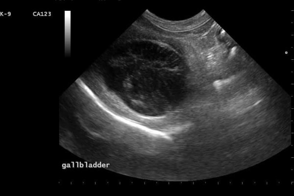 Ultrasound image of a gallbladder with a mucocele present, photo